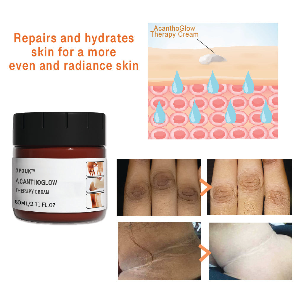 Gfouk™ Acanthoglow Therapy Cream G Fouk 