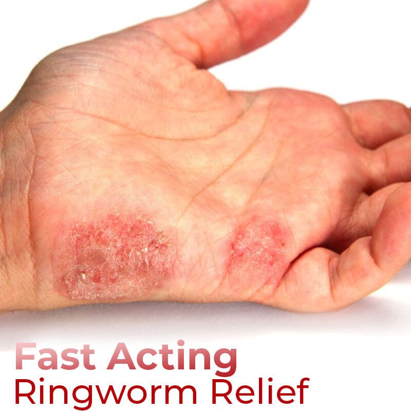 GFOUK™ Hand Ringworm Relief Spray – G-FOUK